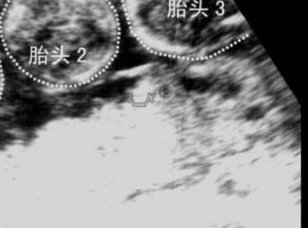 详细解读玉溪市做长方案试管婴儿费用，长方案和短方案成功率有差别吗？