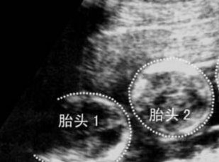 彩虹 恋可以通过试管要孩子吗，彩虹 恋人群试管婴儿怎么做试管婴儿？